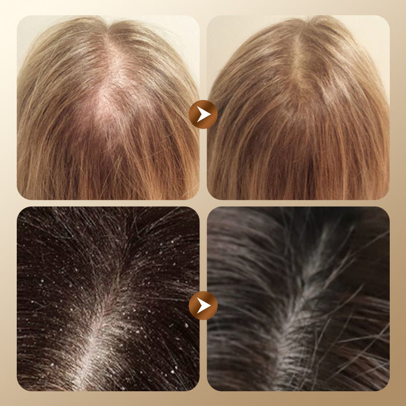 Herbal Hair Loss Prevention and Hair Growth Shampoo